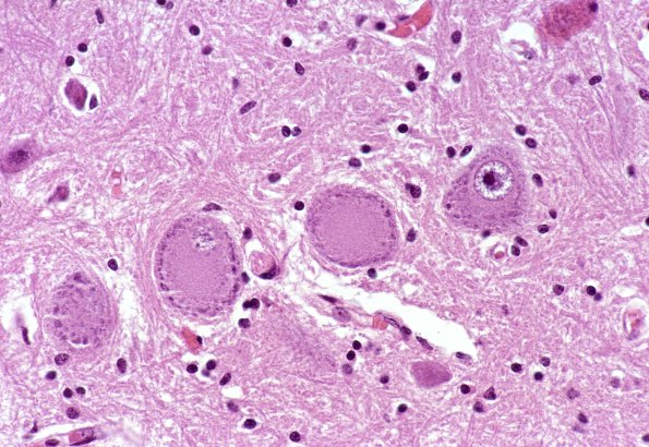 10A3 Central Chromatolysis Mimic (Clarke's column, Case 5) H&E 2