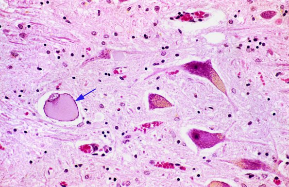 1A1 Neuron, chromatolysis, anterior horn 1