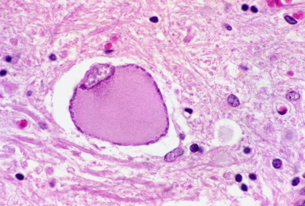 1A2 Neuron, chromatolysis, anterior horn 2