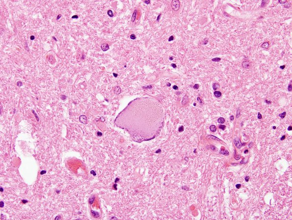 2 Neuron, Chromatolytic (Case 8) 60X 