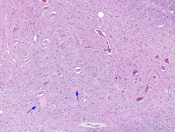 3A1 Central chromatolysis (Case 3) N10 H&E 1