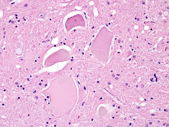 3A2 Central chromatolysis (Case 3) N10 H&E 3