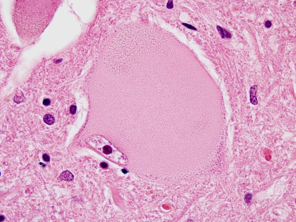 3A3 Central chromatolysis (Case 3) N10 H&E 8