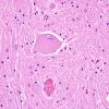 4 Central Chromatolysis 2 (Case 2) H&E 1