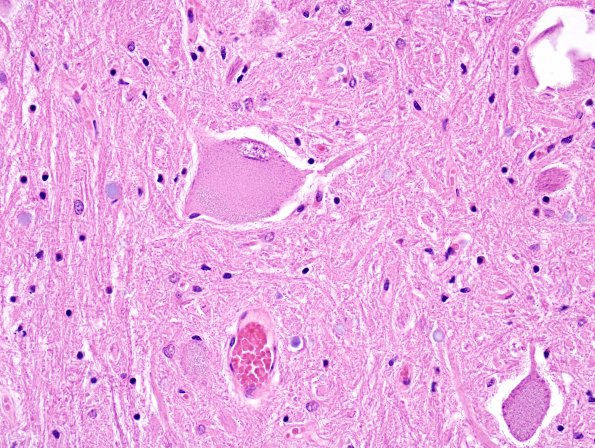 4 Central Chromatolysis 2 (Case 2) H&E 1