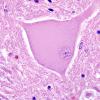 5 Central Chromatolysis L13 (Case 4) H&E 2