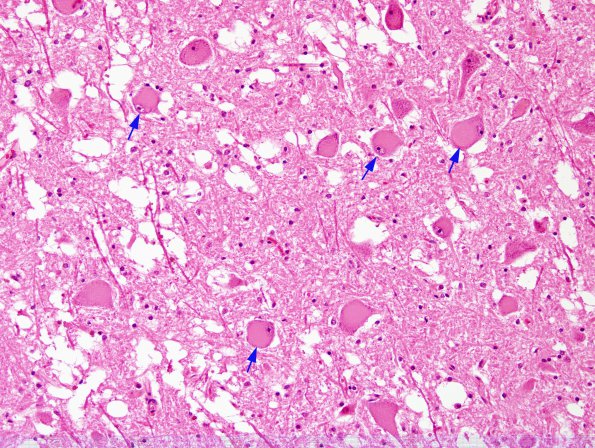 6 Chromatolysis, brainstem, infarct edge (Case 6) H&E 2