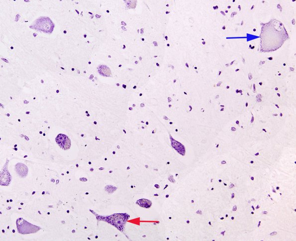 7A1 Neuron, Chromatolysis, pons VII (Case 9) Pons Nissl stain 4