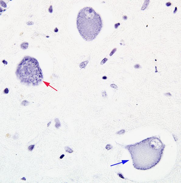 7A2 Neuron, Chromatolysis, pons VII (Case 9) Pons Nissl stain 4