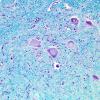 8 Chromatolysis, lymphoma nerve invasion (Case 7) LFB-PAS 3