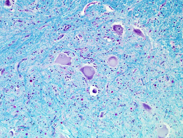 8 Chromatolysis, lymphoma nerve invasion (Case 7) LFB-PAS 3