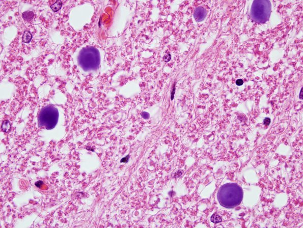 2 Astrocyte, Corpora amylacea (Case 10) H&E 1