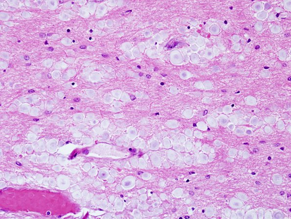 3 Corpora amylacea (Case 14) H&E 2