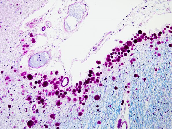 4 Astrocyte, corpora amylacea (Case 15) LFB-PAS 1