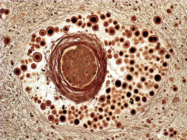 5 Astrocyte, Corpora Amylacea (Case 16) 2 Biels 1