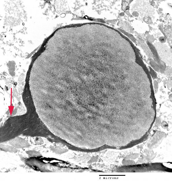 7A2 Astrocyte, corpora amylacea (Case 9) EM 117