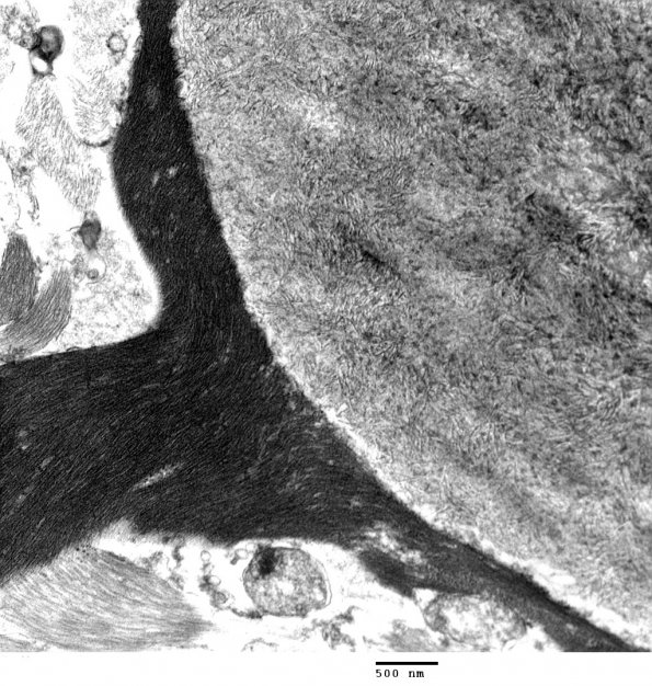 7A3 Astrocyte, corpora amylacea (Case 9) EM 118