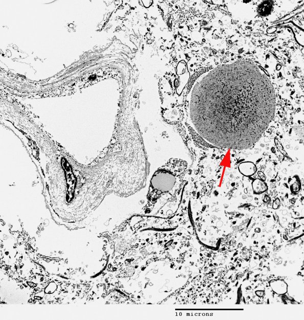 8A1 Astrocyte, corpora amylacea (Case 4) EM 1