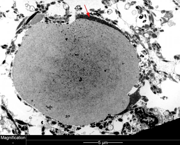 8A2 Astrocyte, corpora amylacea (Case 4) EM 3