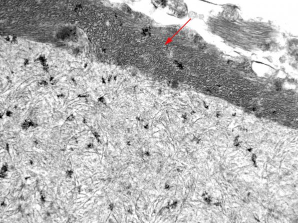 8A3 Astrocyte, corpora amylacea (Case 4) EM 5