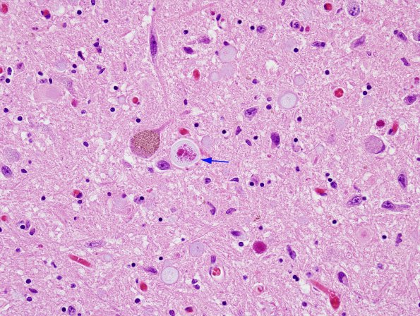 10 Astrocyte, Corpora amylacea-like bodies, DMNX (Case 8) H&E 2