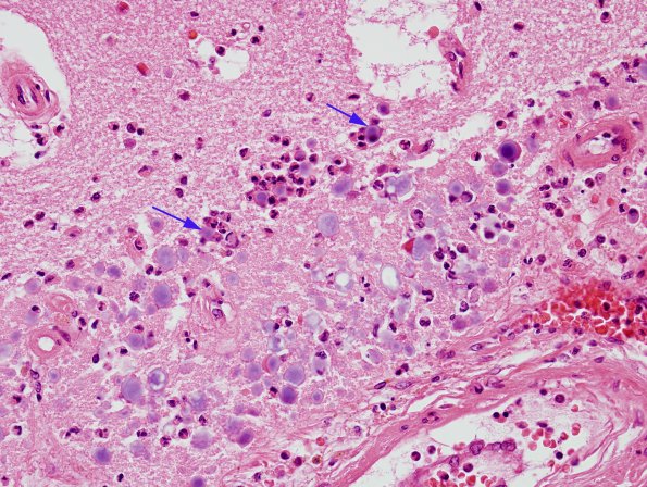 9A2 Astrocyte, Corpora amylacea, PMN attack in infarction (Case 7) H&E 2