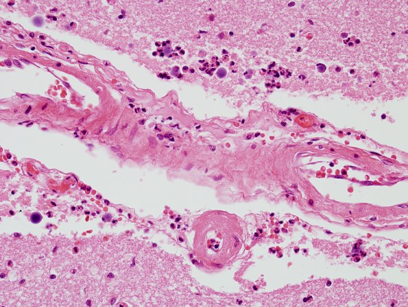 9A3 Astrocyte, Corpora amylacea, PMN attack in infarction (Case 7) H&E 4