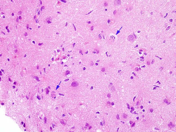 1A1 Creutzfeldt Cell (DDx Granular mitosis) (Case 2) H&E 7