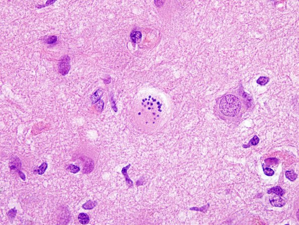 1A2 Creutzfeld Cell (Case 2) H&E 2