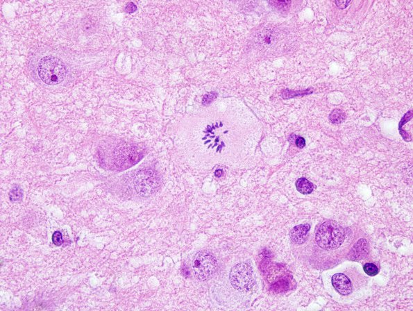 1A4 Granular mitosis (Case 2) H&E 4