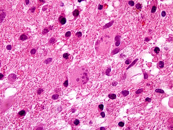 2A1 Creutzfeldt Cells (Case 3) H&E 1