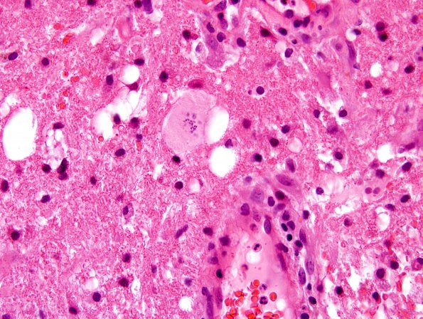 2A2 Creutzfeldt Cell with some granular mitoses in same cell (Case 3) H&E 1