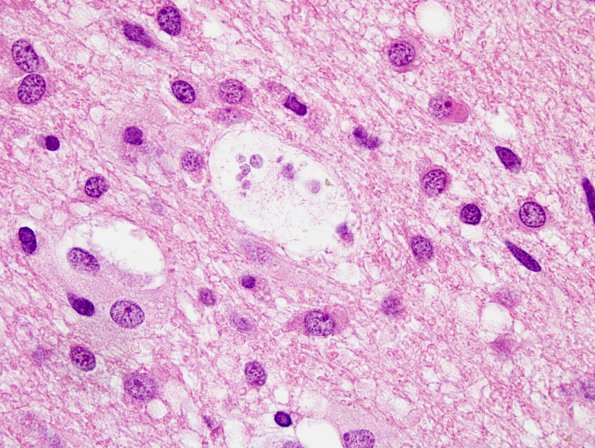 3 Creutzfeldt cell (Case 4) H&E 1