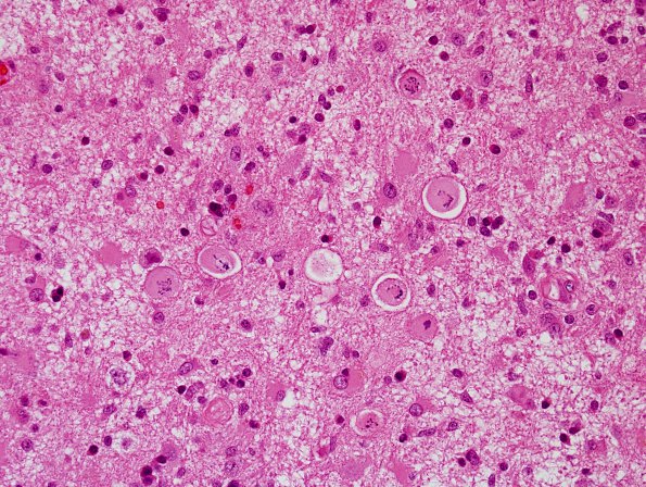 4 Creutzfeldt Cells and Granular Mitoses (Case 5) H&E 40X 1