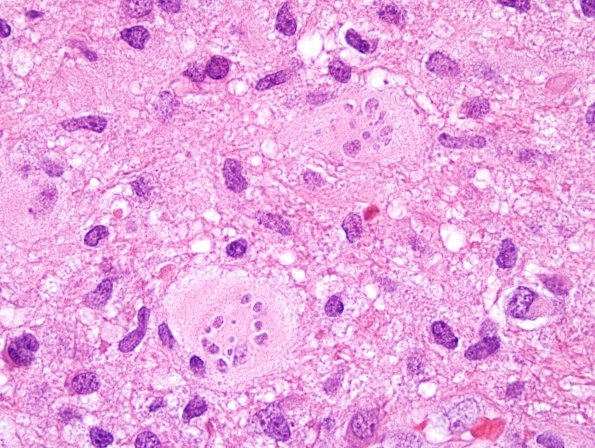 5A1 Creutzfeldt cell in Encephalitis, NOS, immune vs infectious (Case 6) H&E 4