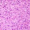 5A2 Creutzfeldt cell in Encephalitis, NOS, immune vs infectious (Case 6) H&E 5