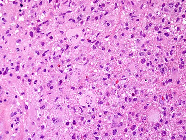 5A2 Creutzfeldt cell in Encephalitis, NOS, immune vs infectious (Case 6) H&E 5