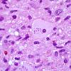 5A3 Creutzfeldt cell in Encephalitis, NOS, immune vs infectious (Case 6) H&E 12