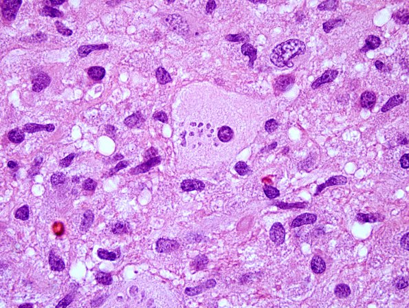 5A3 Creutzfeldt cell in Encephalitis, NOS, immune vs infectious (Case 6) H&E 12