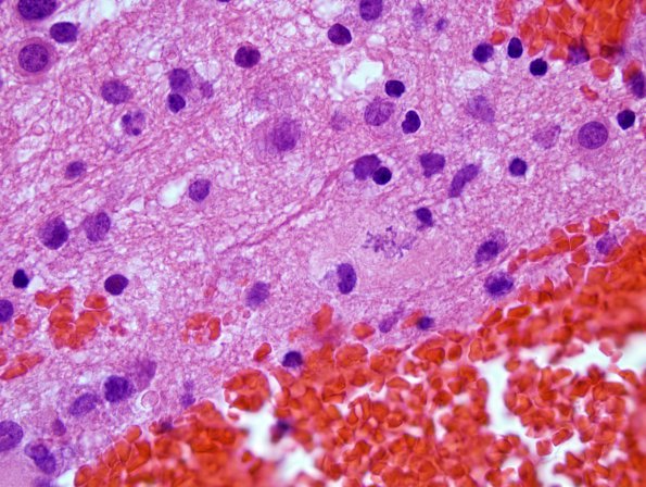 5A4 Granular mitoses in Encephalitis, NOS, immune vs infectious (Case 6) H&E 2