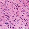 6 Creutzfeldt Cells & Granular Mitoses in GBM (Case 7) H&E 4