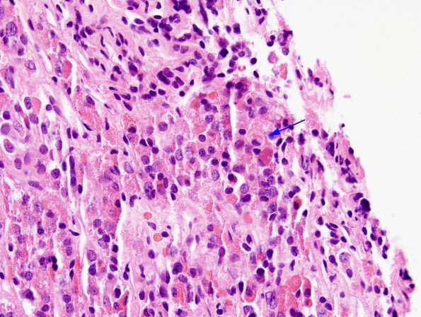 1A1 Crooke's Hyaline change (Case 2) H&E