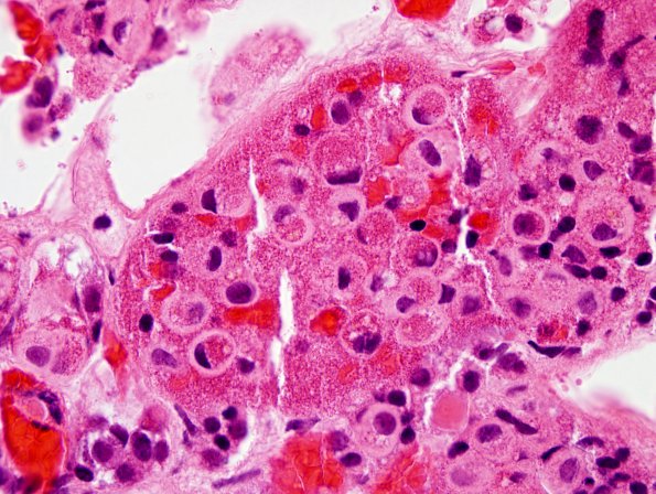 2A1 Crooke's Hyaline change (Case 1) H&E 100X 2