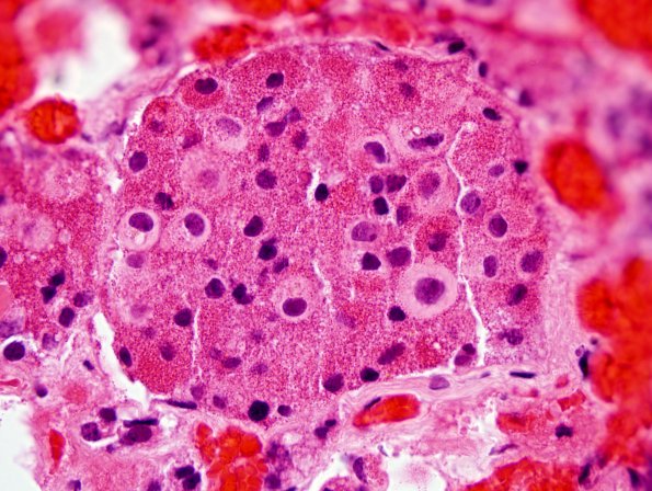 2A3 Crooke's Hyaline change (Case 1) H&E 100X 6