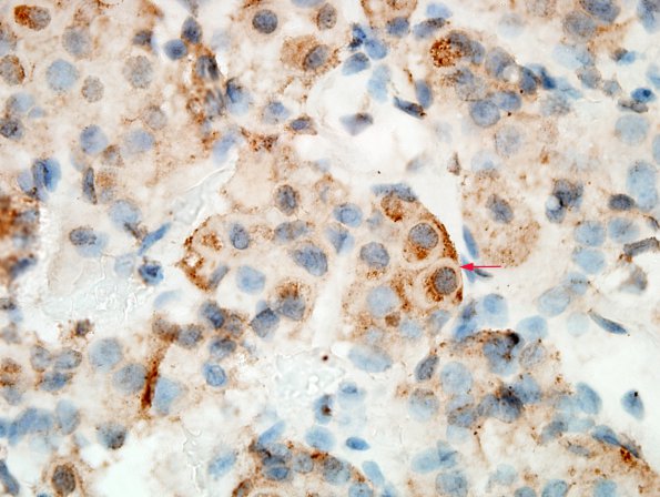 2A4 Crooke's Hyaline change (Case 1) ACTH 1