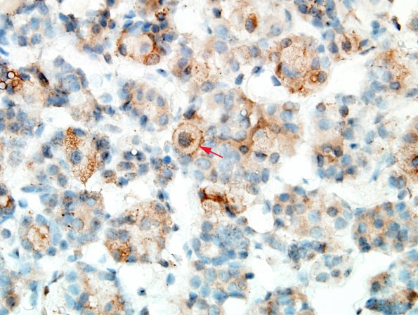 2A5 Crooke's Hyaline change (Case 1) ACTH 4