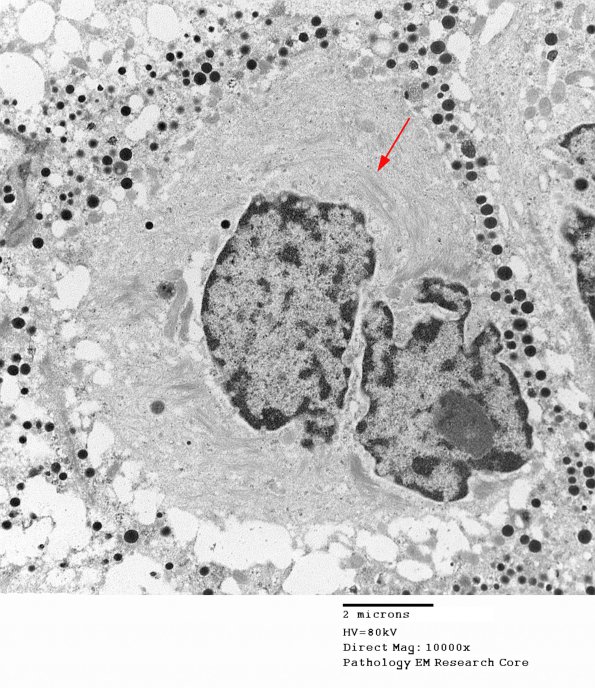 3 Pituitary adenoma (Crooke's Change, Case 3) EM 14