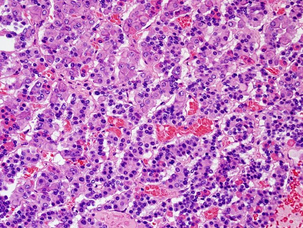 4A1 Empty Sella Syndrome (Case 4) Crooke's change H&E 6