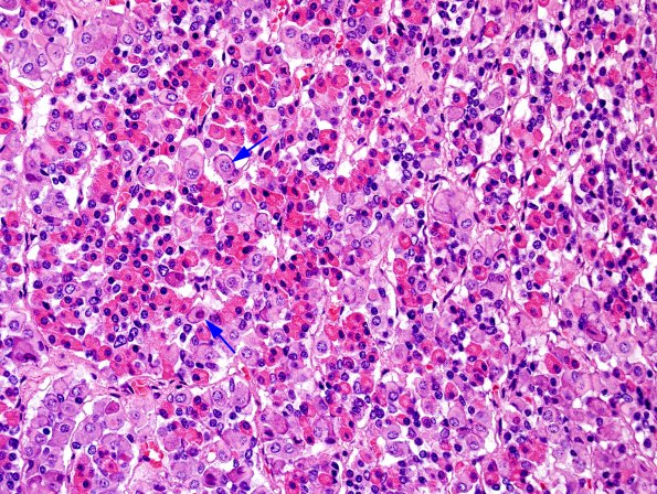 4A2 Empty Sella Syndrome (Case 4) Crooke's change H&E 3 copy