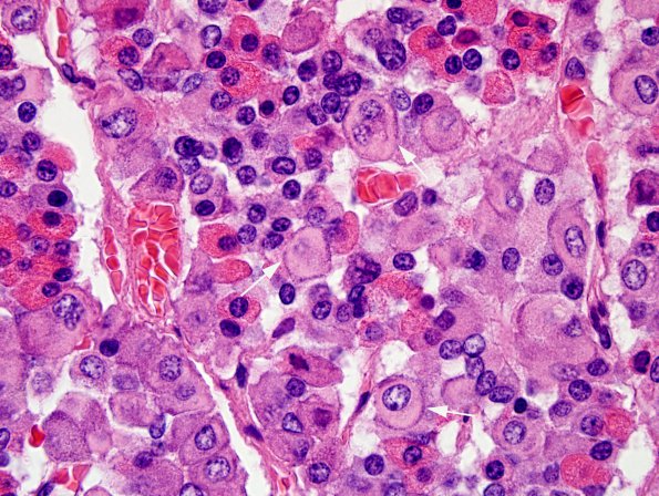 4A3 Empty Sella Syndrome (Case 4) Crooke's change H&E 100X 5 copy